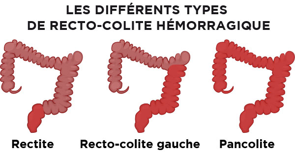 les différents types de rectocolite hémorragique
