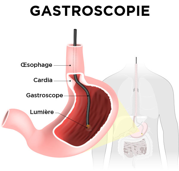 Gastroscopie