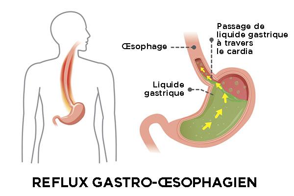 reflux gastro-oesophagien